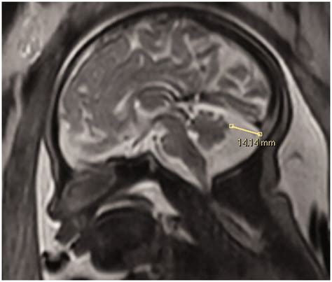cisterna magna radiology|normal cisterna magna measurement.